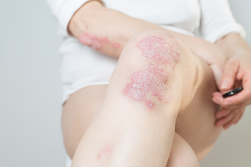 Psoriasis- What Are The Ways to Relieve Irritation and Inflammation on Your Skin?